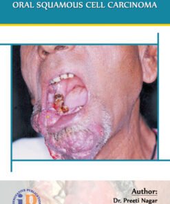 Staging and Grading of Oral Squamous Cell Carcinoma