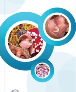 Oral Mycoses