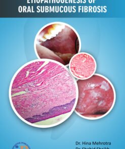 Etiopathogenesis of Oral Submucous Fibrosis